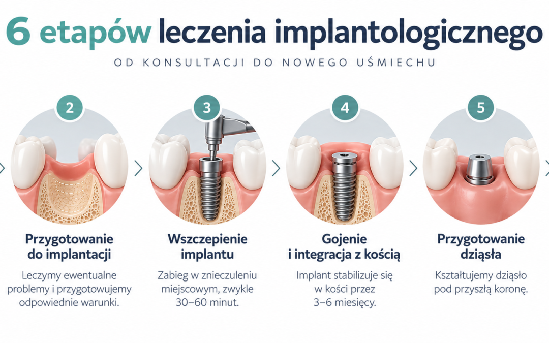 Implanty zębowe – jak wygląda leczenie krok po kroku? Wszystko, co warto wiedzieć przed zabiegiem