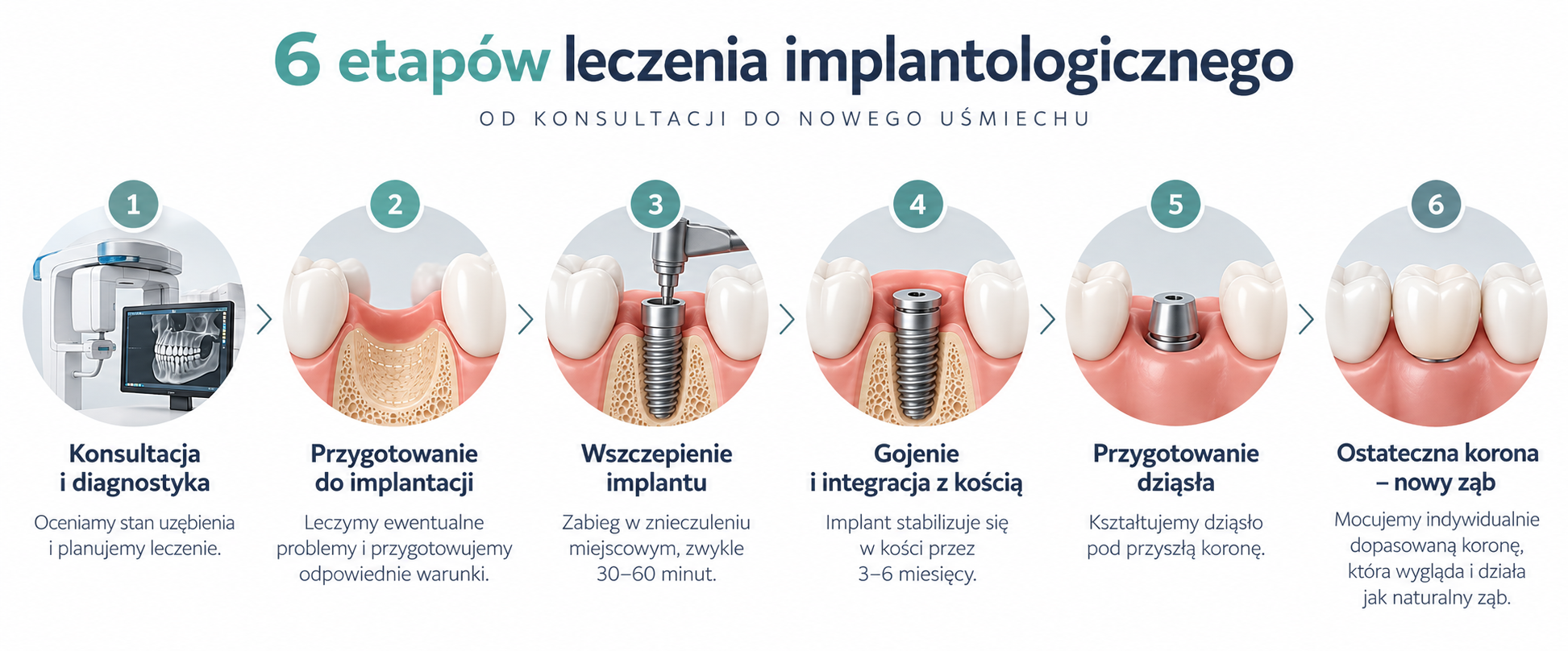 implanty- etapy mplanty zębowe Cieszyn - 6 etapów leczenia implantologicznego, od konsultacji i diagnostyki po wszczepienie implantu i założenie korony.